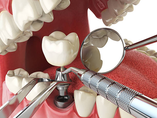Best Emergency Root Canal Treatment in Delft Colony, CA